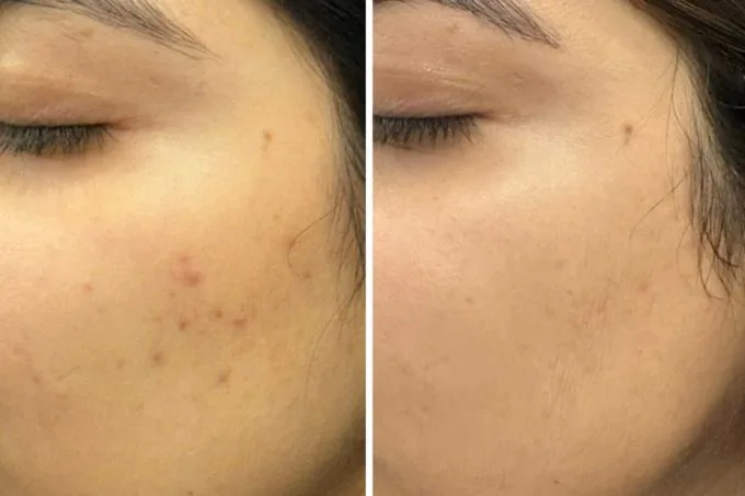 Acne Result